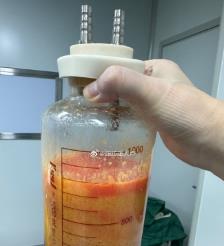 黄骅水动力吸脂手术要做多久？